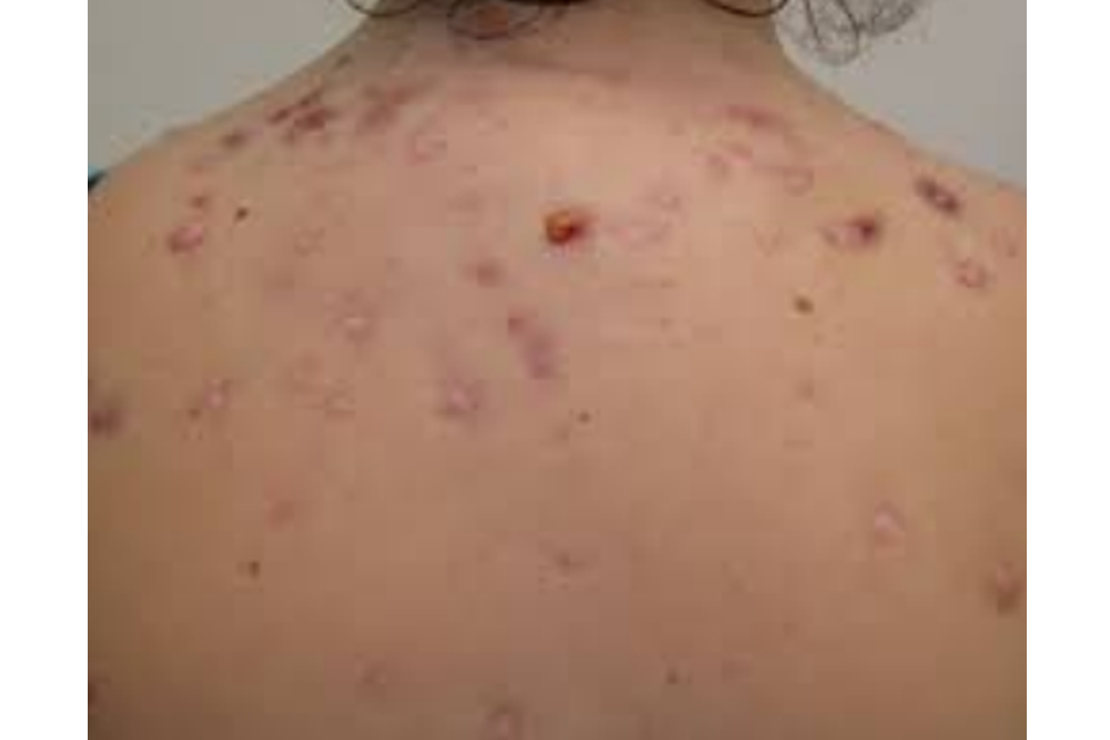 Know about Bacne